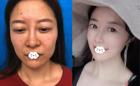 感覺深圳容術面部脂肪填充價格合理，做了科爾曼脂肪填充