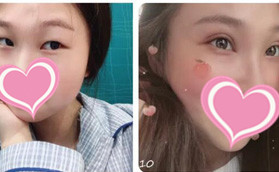 不得不說武漢艾美醫(yī)療美容樊輝華給我割的雙眼皮還挺自然