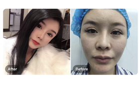 南京繆斯女神醫(yī)療美容診所范家鑫肋軟骨隆鼻案例