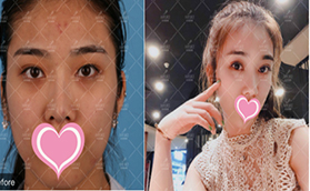 我在北京美萊花費(fèi)上萬元做原生隱痕美眼術(shù)效果真心驚艷