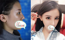 我在美麗焦點(diǎn)做過鼻子,分享焦俊光院長焦式隆鼻照片及價格