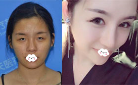 我找深圳春天醫(yī)院楊淑云割雙眼皮時還開內眼角和外眼角了