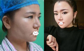 千萬別做光纖吸脂？我找深圳美芮王權(quán)做面部吸脂半年變化