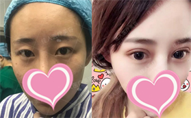 廣州佳人醫(yī)療美容門診部雙眼皮手術全過程公布