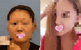 承德玥萊美孫喜平醫(yī)生的耳軟骨復(fù)合隆鼻，效果就像天生的