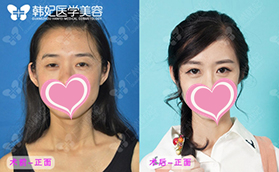 廣州韓妃整形雙眼皮開眼角上瞼下垂矯正手術(shù)案例