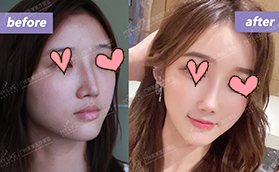 廣州美萊醫(yī)療美容整形醫(yī)院異體骨鼻修復(fù)案例