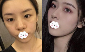 找深圳整鼻子比較有名的醫(yī)生深圳鵬程劉冰做肋軟骨鼻綜合