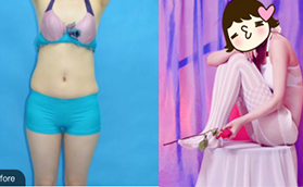 花費四萬多在北京歐揚做的腰腹吸脂給大家看看效果圖