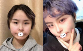 面部填充失敗好后悔 花高價在深圳蘭茂梵美整形做脂肪修復