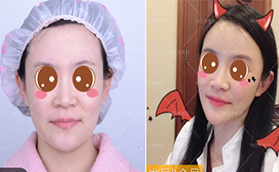 花費三萬多在北京藝美找王東做自體脂肪面部填充失敗修復(fù)