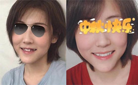 趁價(jià)格優(yōu)惠在深圳世紀(jì)河山口腔做了6顆韓國(guó)美格真種植牙