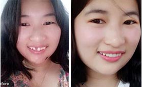 煙臺京韓口腔醫(yī)院種植牙案例