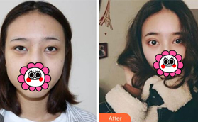 ?找太原楊俊斐做的切開(kāi)雙眼皮剛滿兩個(gè)月忍不住拿出炫耀