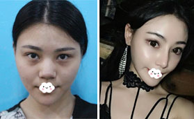 深圳麗港麗格謝俊擅長鼻修復(fù) 選這正規(guī)醫(yī)院做了鼻綜合隆鼻