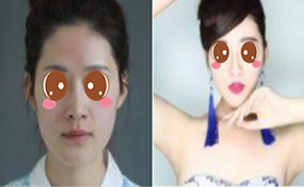 北京禾美嘉正規(guī)靠譜看自體脂肪面部填充+下頜緣溶脂案例