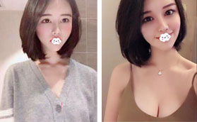 花2W多價(jià)格找深圳富華唐新輝做270CC曼托假體隆胸的手感很軟