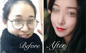 南陽天后醫(yī)療美容醫(yī)院廖丹膨體隆鼻案例