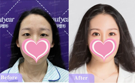 恩施美年華整形醫(yī)院眼部綜合真實(shí)案例前后對(duì)比