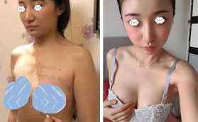 找正規(guī)的深圳軍科劉月更做曼托圓形250CC假體隆胸很靠譜