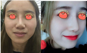 在金華瑞麗整形硅膠假體隆鼻失敗修復(fù)，成功找回了自信！