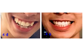 南京月牙兒口腔診所時代天使隱形矯正案例分享