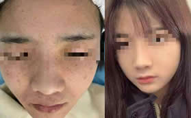 曬曬我花3800元在重慶光博士做c10激光祛斑2個月變化圖片