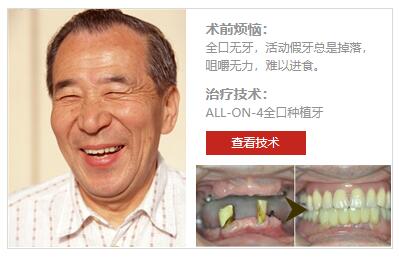 惠州致美All-on-4種植牙，一小時(shí)4顆種植體解決半口無(wú)牙問(wèn)題