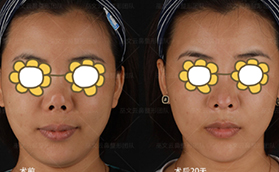 兩次隆鼻失敗變朝天鼻五萬找北京米揚(yáng)麗格巫文云做鼻修復(fù)