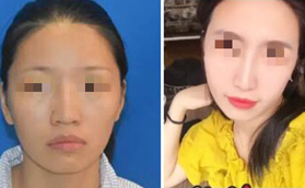 真實投稿武漢亞韓趙貴慶磨骨案例，4萬就能讓臉型明顯改變