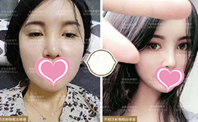 北京奧美定取出哪家好？柏麗李勁良取出之后做鼻綜合案例