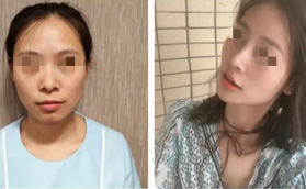 了解武漢美基元汪福強(qiáng)口碑后，找他做鼻綜合手術(shù)花了3萬(wàn)多