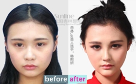 沈陽杏林整形醫(yī)院朱石江下頜角縮小術(shù)+硅膠隆鼻案例