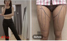 南京嘉怡美醫(yī)療美容竹張健腰腹大腿吸脂案例分享