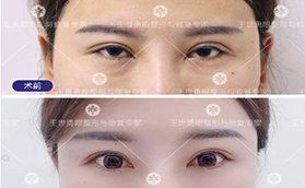 王世勇修復(fù)雙眼皮多少錢？案例價(jià)格表看北京東方百合正規(guī)