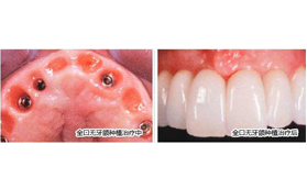 種植牙疼么?在太原美齒牙科體驗(yàn)過的親身經(jīng)歷者多圖演繹