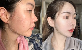 武漢華美付國友磨骨技術怎么樣？看我花了3萬找他做下頜角