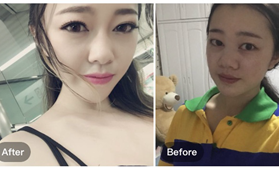 南京河西美容醫(yī)院方新友眼綜合修復(fù)+鼻綜合案例分享