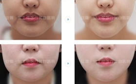 沈陽安娜寶士麗徐云泳全面部提升，解鎖減齡新趨勢