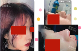 成都雍和華仁整形美容醫(yī)院肋骨鼻綜合前后對(duì)比照