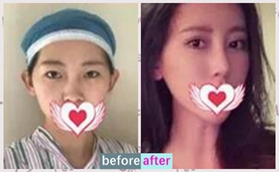 沈陽(yáng)云惠美醫(yī)療美容做完耳軟骨復(fù)合隆鼻后竟不懼揉捏