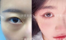 閨蜜陪我去做雙眼皮失敗修復，術后效果讓她沖動做了切開