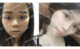 在惠州鵬愛做了開扇形雙眼皮剛拆線，就又做了耳軟骨隆鼻