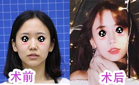廈門微格整形張民福自體脂肪填充全臉的3個月案例對比圖