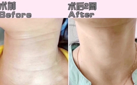 沈陽(yáng)瑞妍醫(yī)療美容診所譚佳男嗨體去頸紋，美出天鵝頸