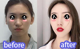 我在廈門酉西兒找莊錦波肋軟骨隆鼻100天效果對比圖