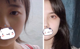 高中畢業(yè)在惠州時(shí)光做全切雙眼皮花了5000元，效果像媽生的