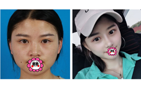 聽說肋骨鼻4個月就塌了,但我找吳氏嘉美莊蔚強做的特別好