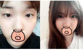 天了嚕！青海潤(rùn)美做的扇形雙眼皮竟然五天就拆線！