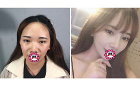 分享云南昆明銅雀臺(tái)杜亞旭做半肋骨隆鼻三個(gè)月變化效果圖